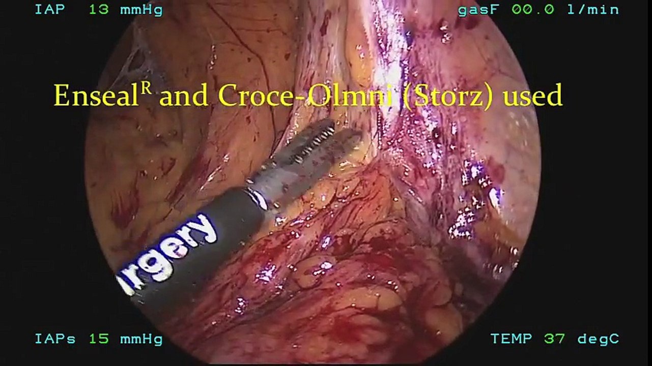 Obliterated Umbilical Artery Dissection