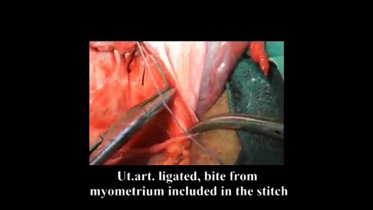 Stepwise Devascularization of Uterus