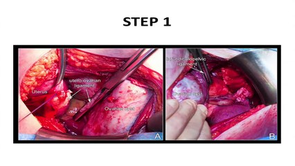 Excision of a Giant Ovarian Cysts without spillage of its contents