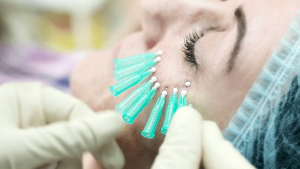 اكتشفي تقنية الخيوط الرفيعة لمعالجة التجاعيد حول العينين