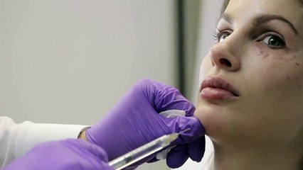 Voluma Chin Filler with Liz and Dr. Harper