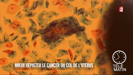 Santé - Mieux dépister le cancer du col de l’utérus