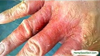 How To Get Rid Of Eczema Naturally - Natural Eczema Treatment