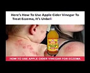 How To Use Apple Cider Vinegar To Treat Eczema, It’s Unbelievably Effective