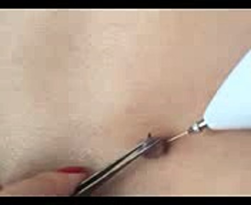 mole removal pen 3