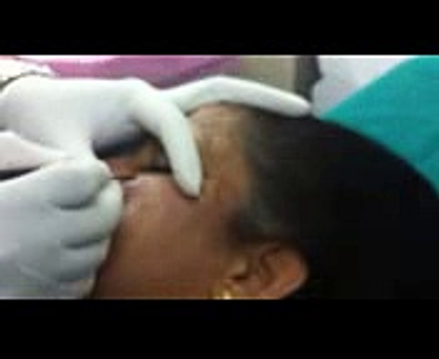 MOLE REMOVAL  TREATMENT, Dr. KULDEEP SINGH SKIN CLINIC, AHMEDABAD GUJARAT