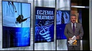 New Eczema Treatment
