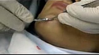 Scarless Scar Free Pain Free Mole Removal by Beverly Hills top plastic surgeon