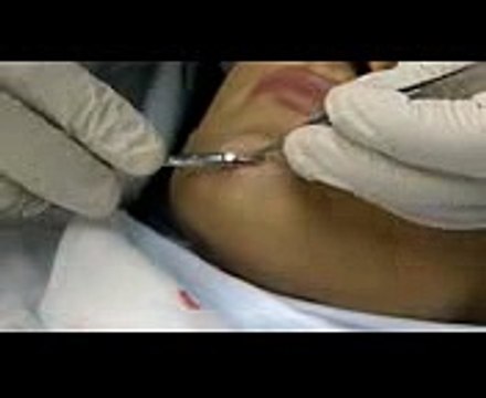 Scarless Scar Free Pain Free Mole Removal by Beverly Hills top plastic surgeon