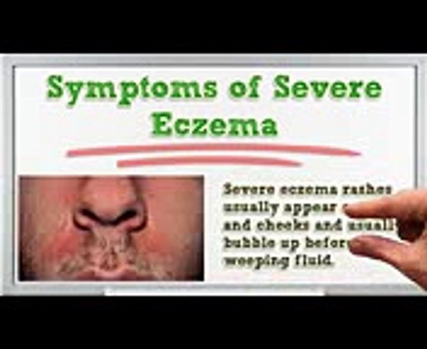 Severe Eczema - Severe Eczema Treatment - Severe Eczema Remedies - Severe Eczema Pictures