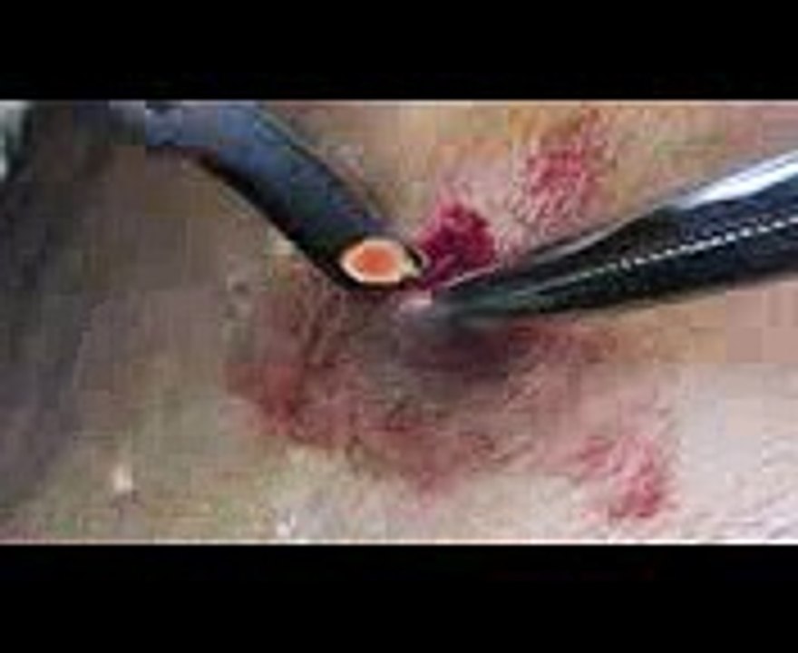 Mole removal on the forehead