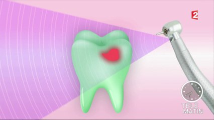 Santé - Un nouveau traitement ciblé pour mieux traiter les caries