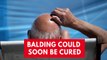 New hair loss treatment could cure balding