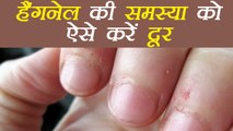 Hangnail: हैंगनेल की समस्या को दूर करेंगे ये उपाय | How to Get Rid of Hangnails | Boldsky