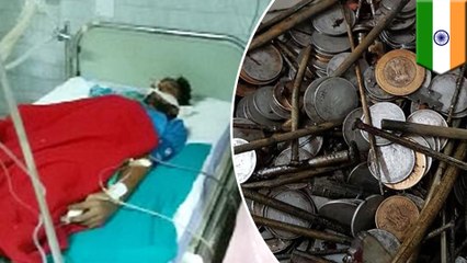 Indian man found with 263 coins and 100 nails in his stomach