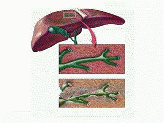 Cholangite sclérosante  primitive et maladies inflammatoires chroniques de l'intestin