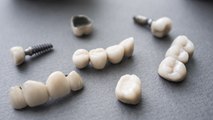 كيف تتم عملية زرع الأسنان؟
