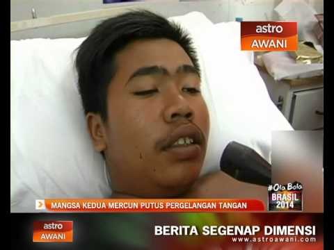 Pelajar putus tangan kanan akibat mercun