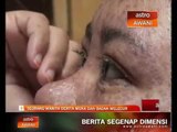 Seorang wanita derita muka dan badan melecur