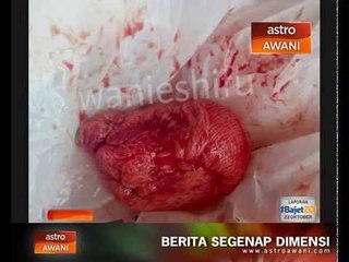 Tertinggal kain dalam rahim: Suami fail saman