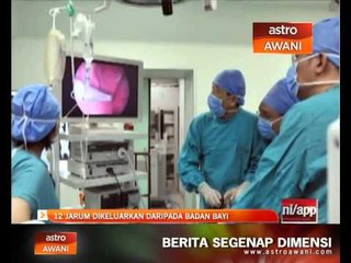 12 jarum dikeluarkan daripada badan bayi