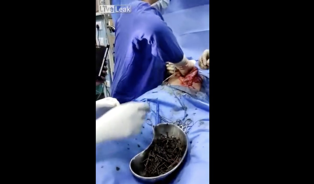 Having a Surgery to remove Nails from his stomach !