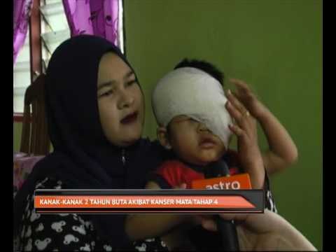 Kanak-kanak dua tahun buta akibat kanser mata tahap empat