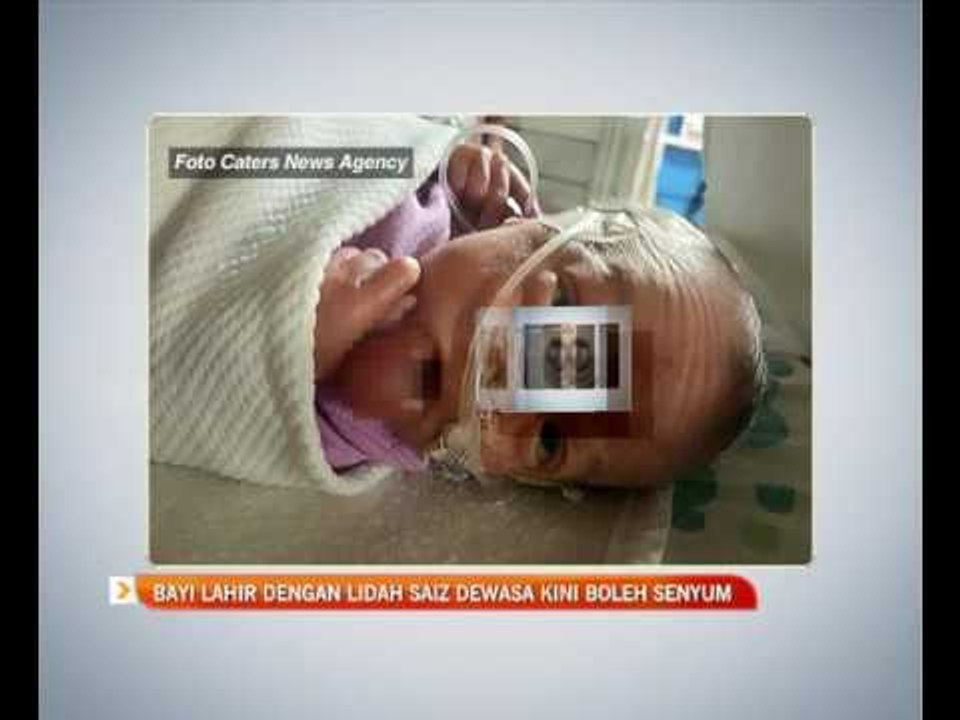 Bayi lahir dengan lidah saiz dewasa kini boleh tersenyum