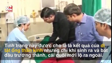 Chàng trai Ấn Độ phẫu thuật cắt đuôi 20cm