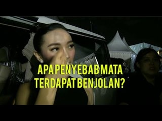 Zaskia Gotik Cerita Awal Muncul Benjolan di Matanya