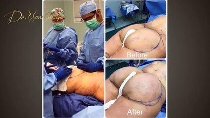 How soon will I see the final results of butt augmentation?