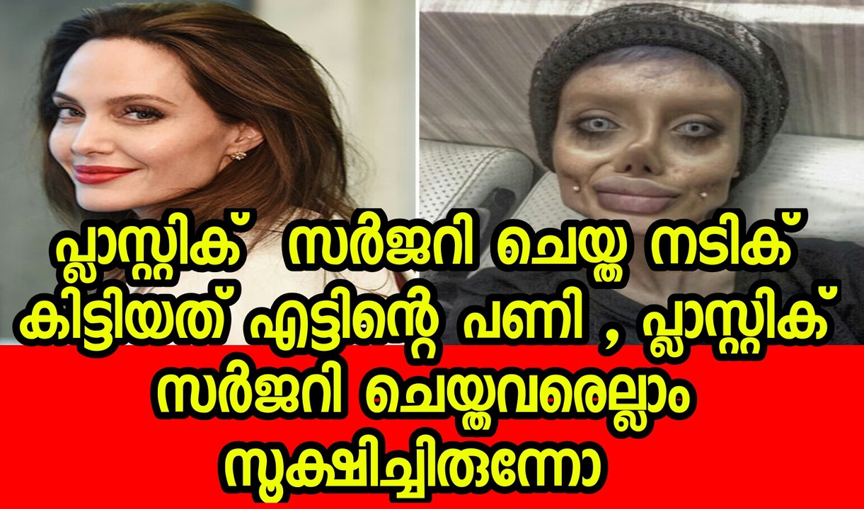 പ്ലാസ്റ്റിക്  സർജറി ചെയ്ത നടിക് കിട്ടിയത് എട്ടിന്റെ പണി| Zombie’ teen who claimed she had fifty ops to look like Angelin