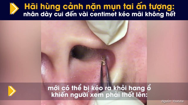 Hãi hùng cảnh nặn mụn tai ấn tượng: nhân dày cui đến vài centimet kéo mãi không hết