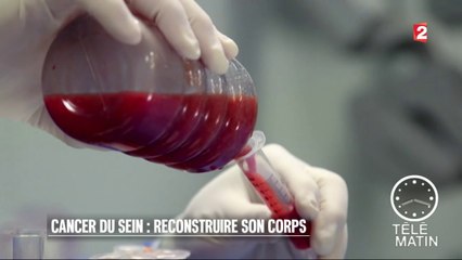 Santé - Le Lipomodelage : enfin remboursé après un cancer du sein !