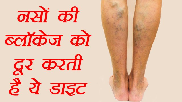 बंद नसों को खोलती है ये डाइट | Diet for blocked Veins | Varicose veins | Boldsky