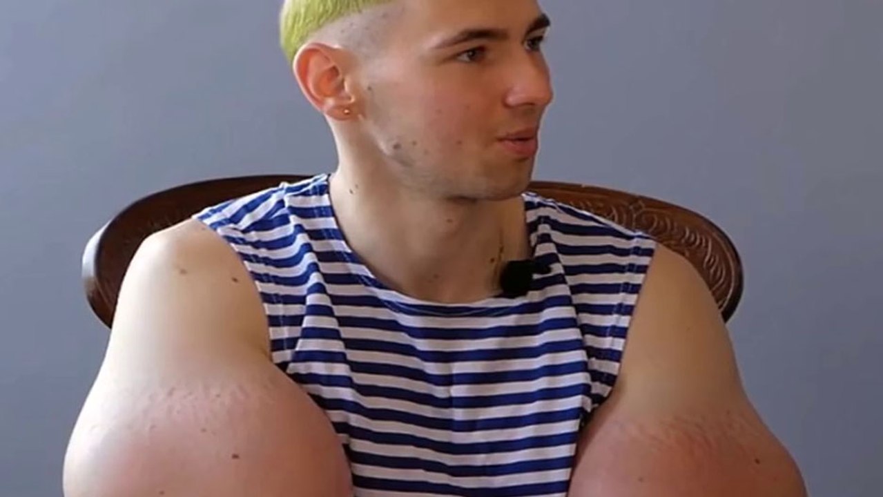 Un jeune homme subit les conséquences des injections de synthol dans les muscles