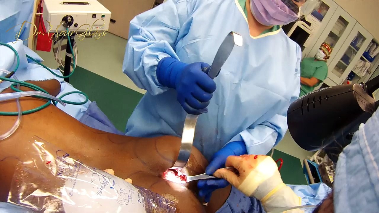 Scarring After Butt Implants Surgery