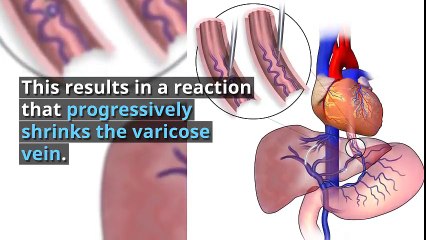 Varicose Veins Treatment San Diego