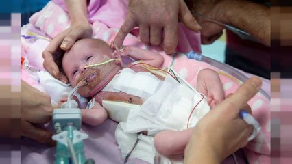 Bambina "miracolata": nasce con il cuore fuori dal petto ma sopravvive