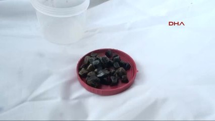 Denizli Taş Ocağı Gibi Safra Kesesi