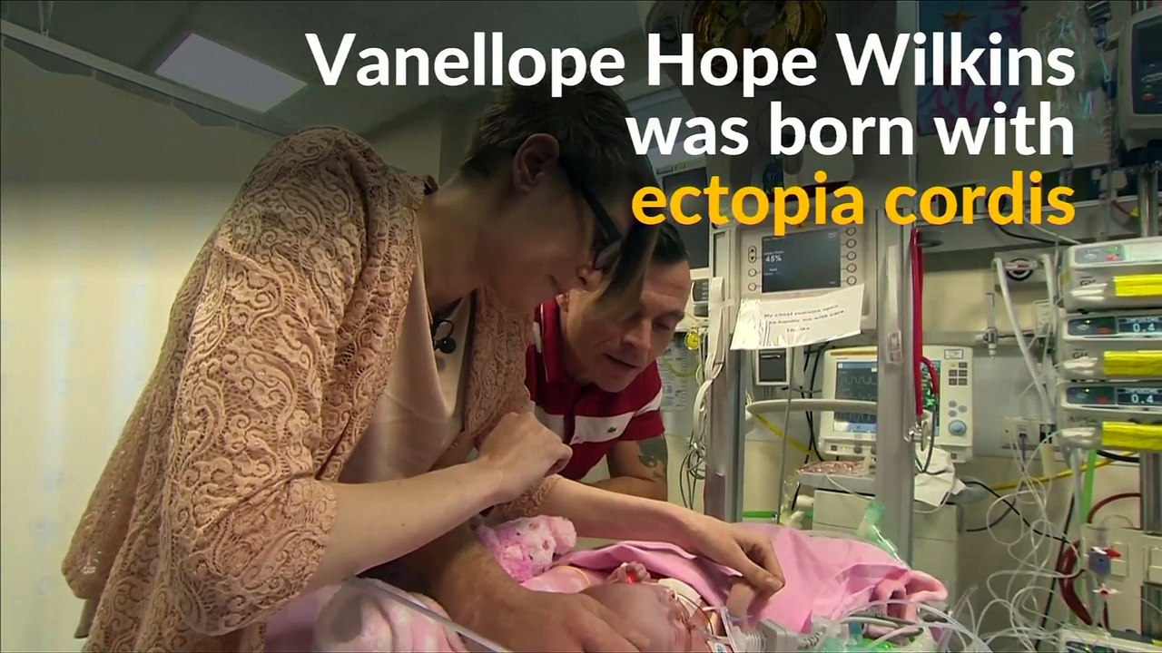 Uk Baby Born With Heart Outside Body Survives Surgery