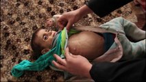 La fame dei bambini in Siria