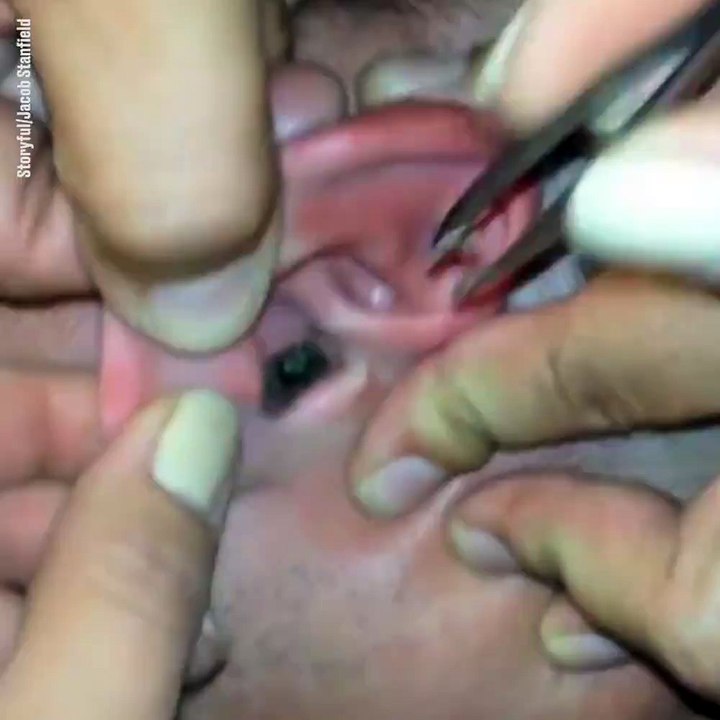 Il avait un papillon coincé dans l'oreille... L...