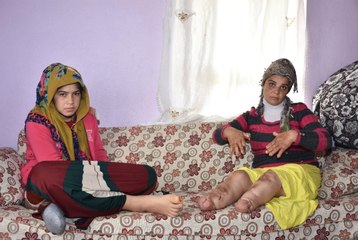 Doktorların Çare Bulamadığı Genç Kızın Elleri ve Ayakları Eriyor
