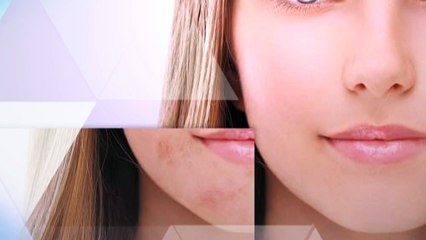 Acne Specialist Treatment Center in Florida