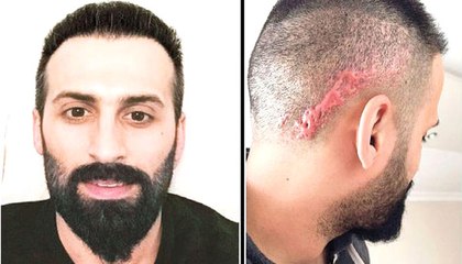 Saç Ekimi Yaptırmak İsteyen Gencin Kafa Derisinde Yara Oluştu Y