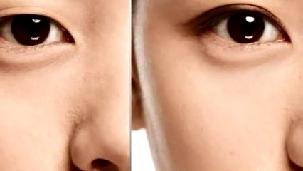 Đôi mắt có hồn nhờ công sức rất lớn từ nhấn mí Hàn Quốc