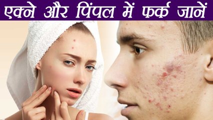 Acne and Pimples Differences & remedies | एक्ने और पिंपल्स में फर्क जानना ज़रूरी | Boldsky