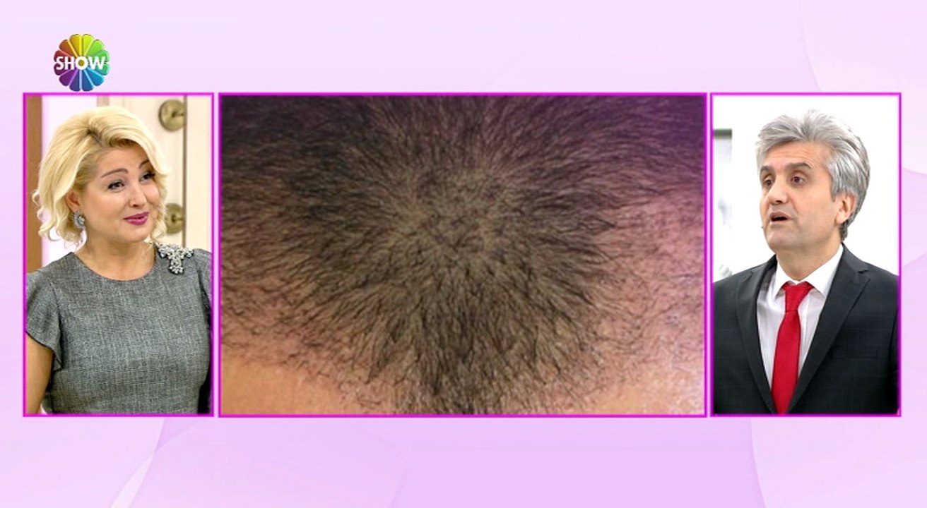 Doç. Dr. Hayati Akbaş - Saçın Dökülmesine Hangi Hormon Neden Olur? Show Tv