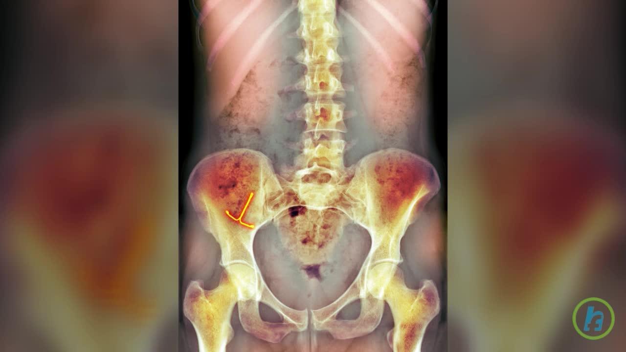 Dispozitivul intrauterin